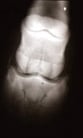 Fracture of Navicular Bone in Horses