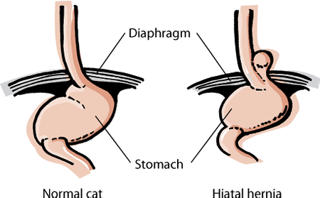A hiatal hernia involves the extension of part of the stomach through the diaphragm.
