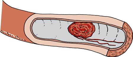 Blood clots may obstruct blood flow.
