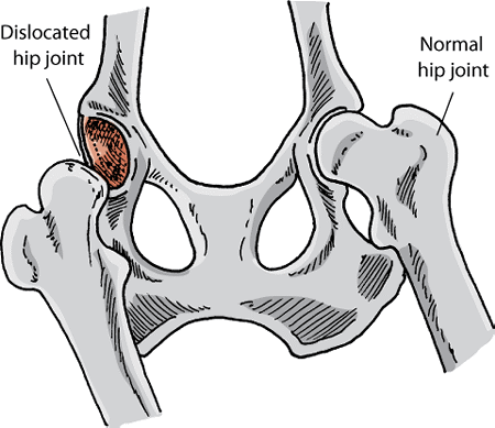 A normal and a dislocated hip joint of a dog