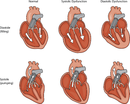 Heart failure may involve systolic or diastolic dysfunction. In diastolic dysfunction, the heart wall is thickened and not enough blood is able to fill the lower chambers before being pumped to the body. In systolic dysfunction, the heart wall is stretched and weak, making it unable to pump out enough blood. Both conditions lead to poor circulation.