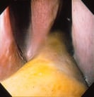 Diseases of the Paranasal Sinuses in Horses