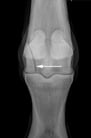Fracture of the Third Metacarpal (Cannon) Bone in Horses