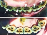 Eruption of the Teeth a