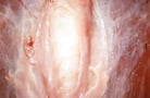 Breast Blisters in Poultry