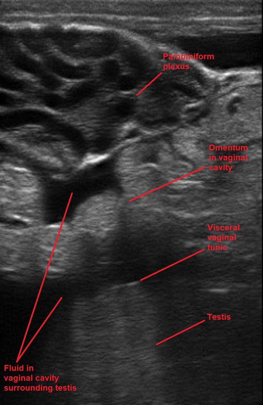 Inguinal hernia, ram, ultrasonograph